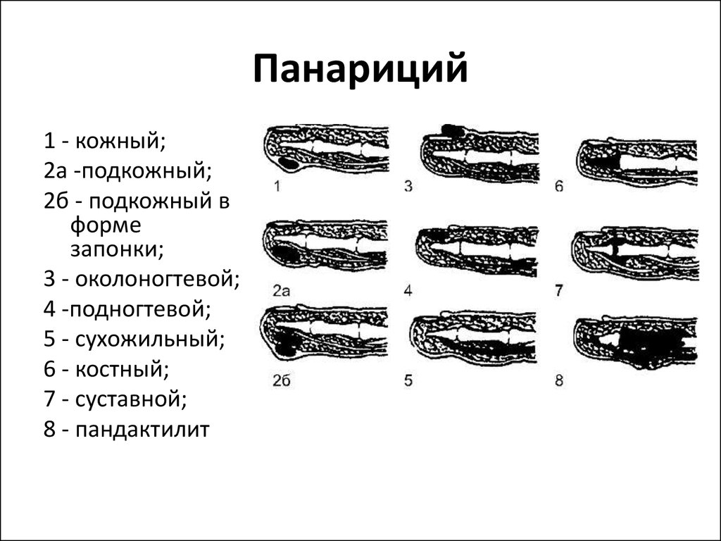 Лечение панариция на пальце ноги - подробное описание