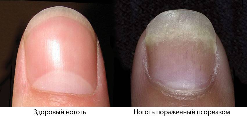 Псориаз волосистой части головы