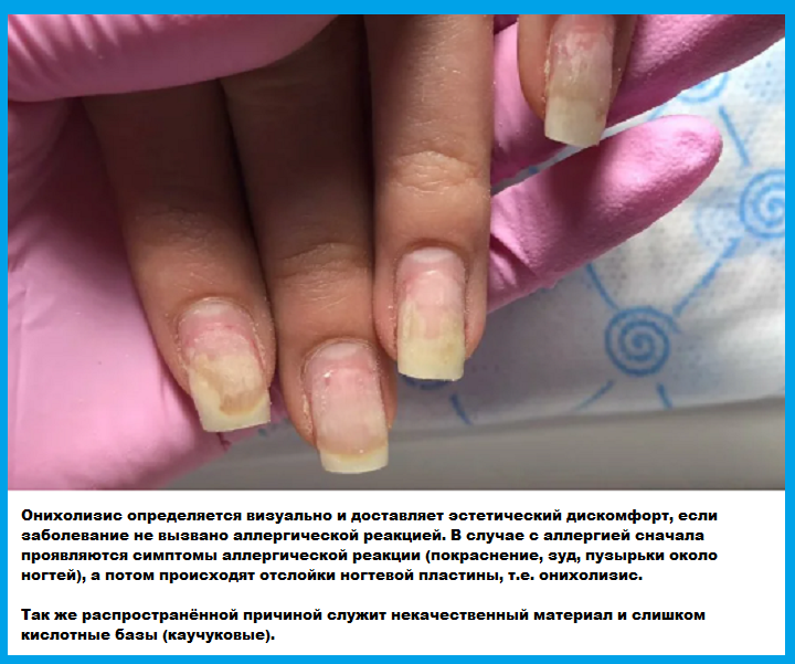 Лечение онихомикоза ногтей: препараты недорогие, но эффективные