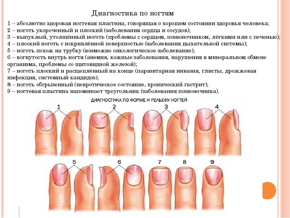 Онихомикоз (грибок ногтей). причины, симптомы, признаки, диагностика и лечение патологии :: polismed.com
