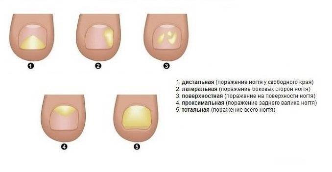 Ониходистрофии