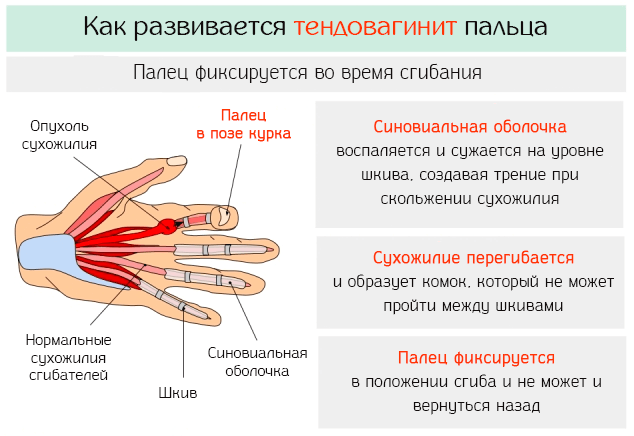 Деформация пальцев рук и ног - к кому обращаться? - медицинский центр "звезда"