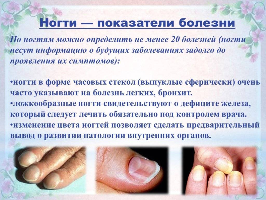 Грибок ногтей на ногах: лечение, стадии, причины