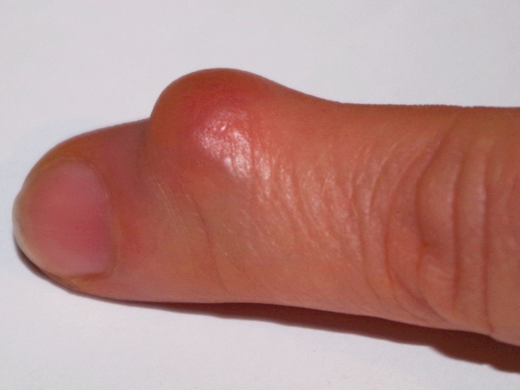 Padrastro infectado dedo