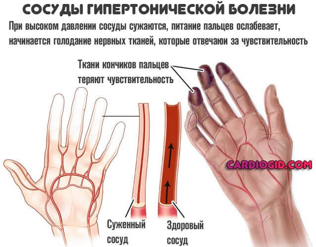 Почему щелкают пальцы? что такое болезнь нотта?
