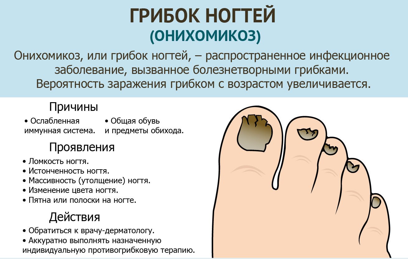 Онихомикоз (грибок ногтей). причины, симптомы, признаки, диагностика и лечение патологии
