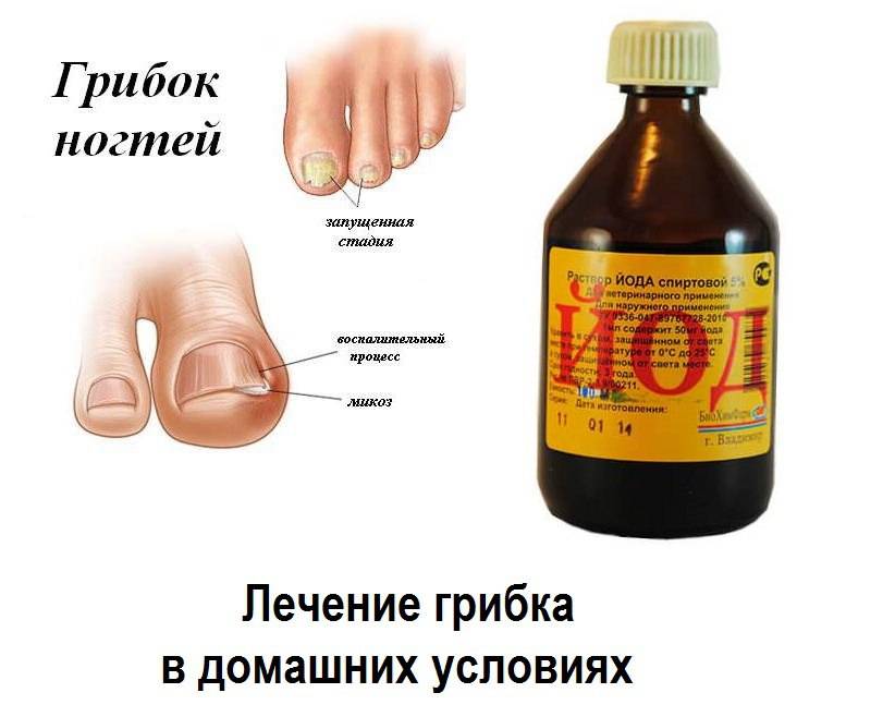 Рубромикоз ногтей: фото, симптомы, лечение