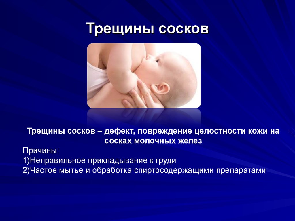 Опрелости у новорожденных детей: причины появления, профилактика, кремы для ухода