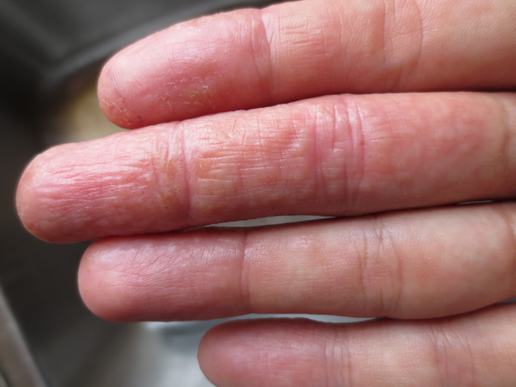 Почему шелушатся руки (ладони)  и ноги (стопы) -  патологические механизмы шелушения кожи