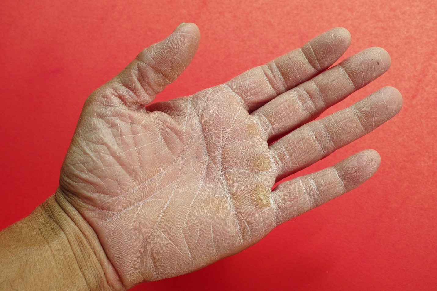 Артроз кистей рук - симптомы и лечение заболевания суставов