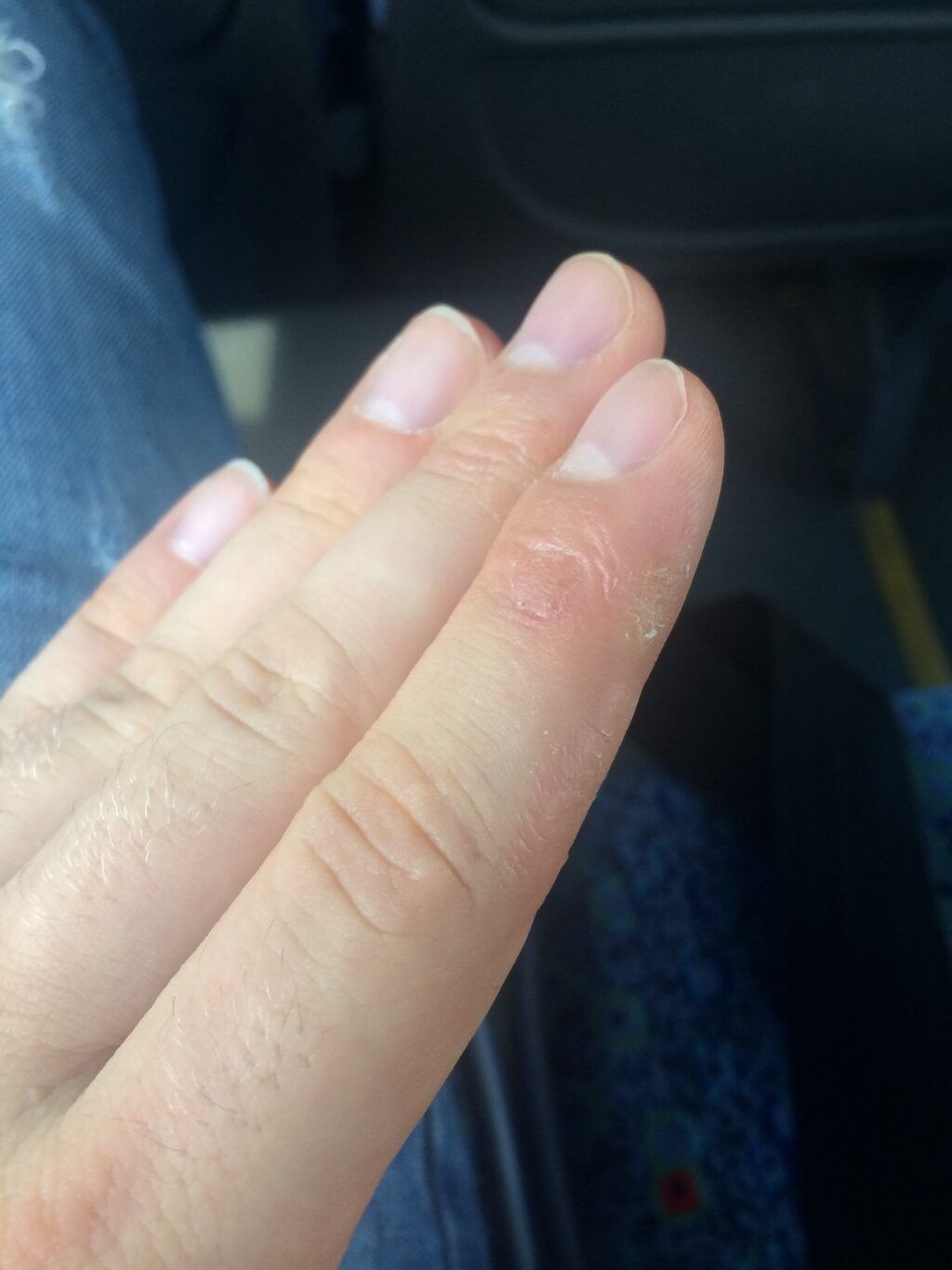 Почему шелушится кожа на пальцах рук, что нужно делать? методы лечения