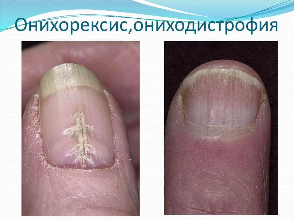 Онихомикоз (грибок ногтя) - причины, симптомы, диагностика, лечение и профилактика