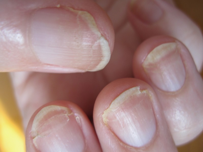 Средства для лечения грибка ногтей — самые эффективные лекарства
