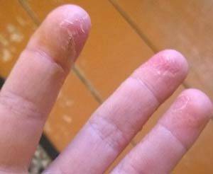 Причины сухой кожи на подушечках пальцев рук и способы устранения проблемы | moninomama.ru