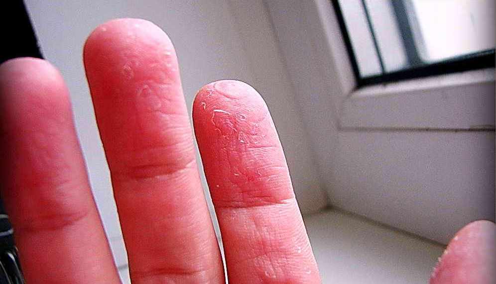 Шелушится кожа на пальцах рук: каковы симптомы и причины, а также почему иногда трескается и облезает только на кончиках, что делать и методы лечения