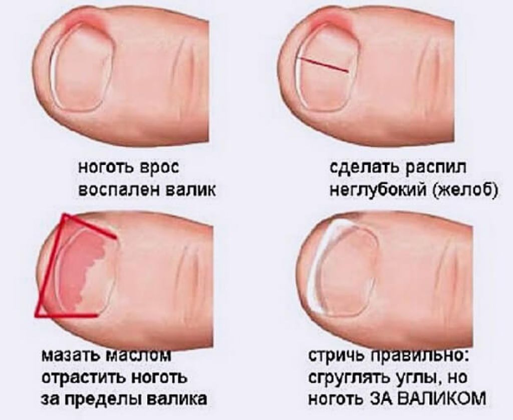 Грибок ногтей