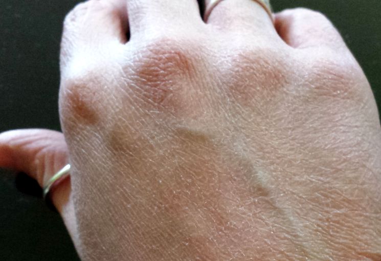 Кожа на пальце руки трескается: причины и лечение народными средствами