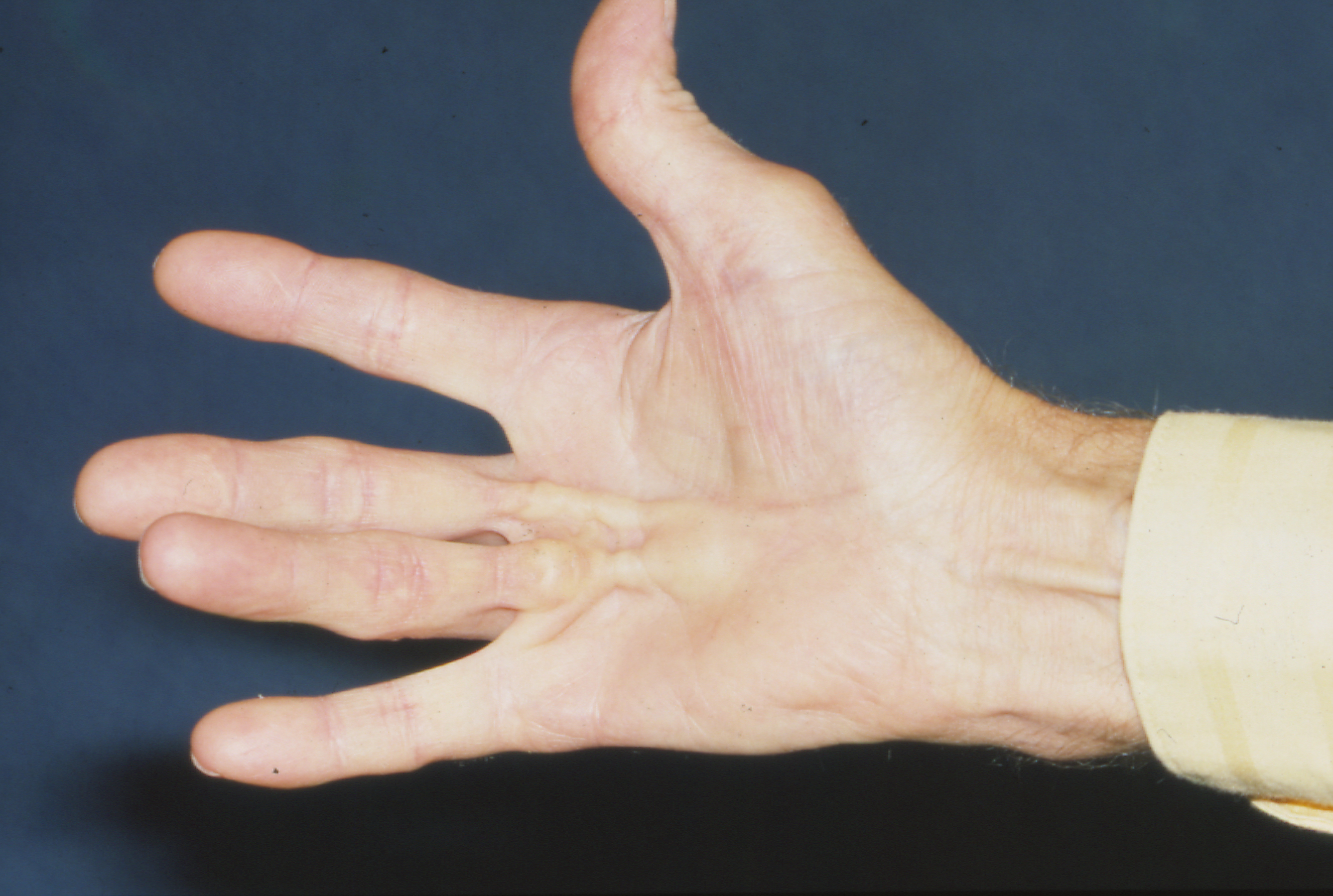 Вальгусная деформация пальца стопы: особенности развития и лечения патологии