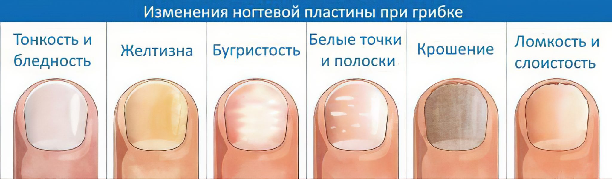 Подногтевая меланома, рак ногтевой пластины: излечение, симптомы, начальная стадия рака ногтя | клиники «евроонко»