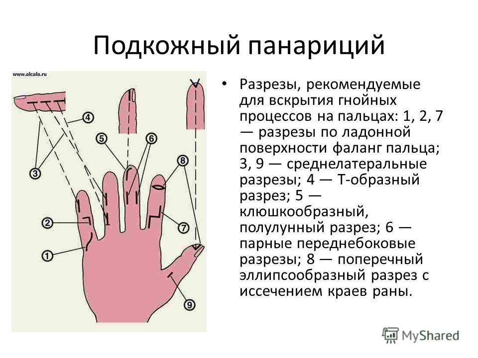 Причины, симптомы и лечение панариция. амбулаторная хирургия во владивостоке