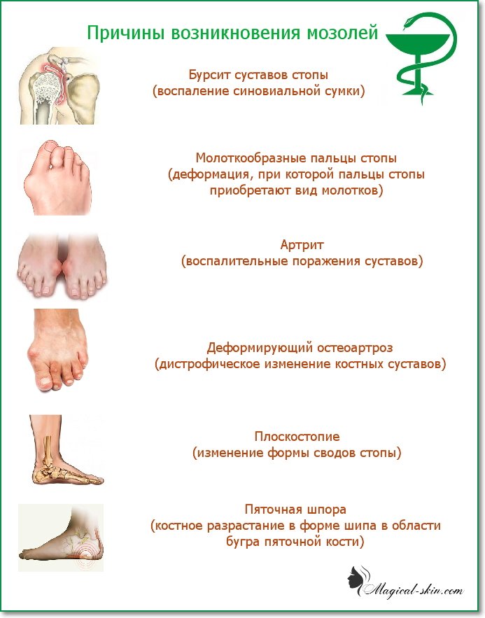 Мозоль корневая (стержневая) | центр подологии и остеопатии татьяны красюк