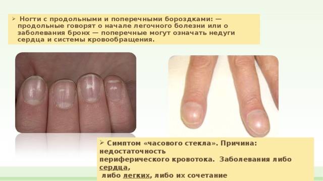 Лечение и профилактика лейконихии, белых пятнен на ногтях — центр подологии podolab