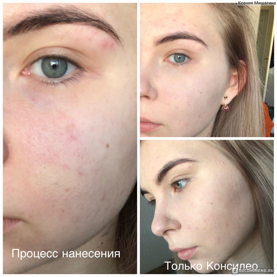 Как замаскировать прыщи макияжем и подручными средствами