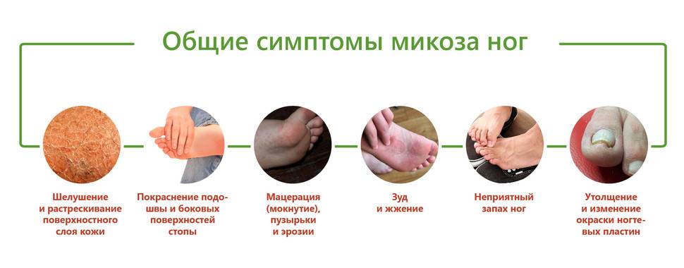 Грибок ногтей
