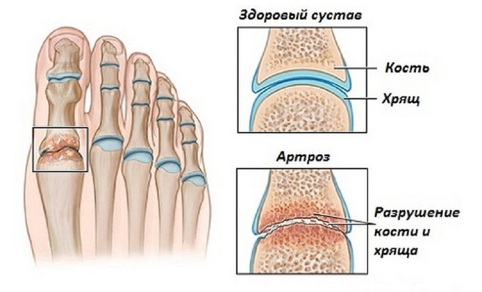 Лечение болезней и повреждений ногтей и кутикулы. о чём говорят деформации, ломкость и изменение цвета ногтей