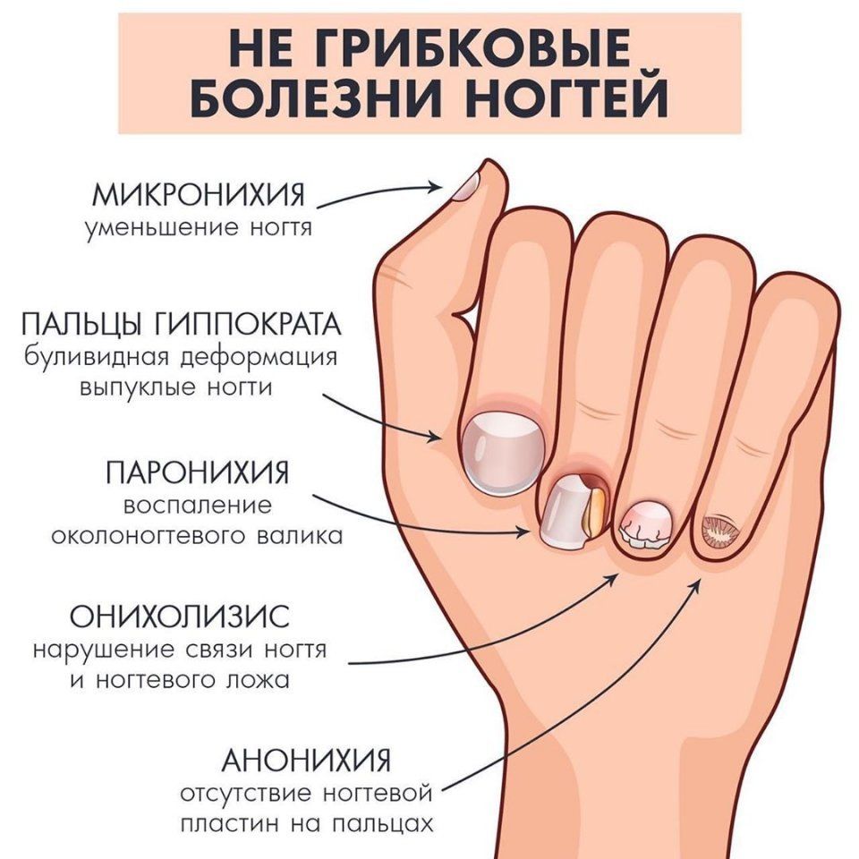 12 проблем с ногтями, которые служат симптомами заболеваний – не пропустите их | evolutis clinic | дзен