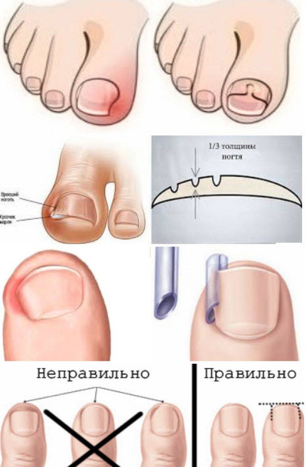 Вросший ноготь на ноге - что делать, как подстричь и лечить онихокриптоз