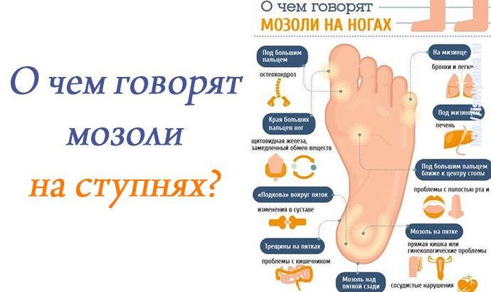 Сухая мозоль: причины появления и методы удаления