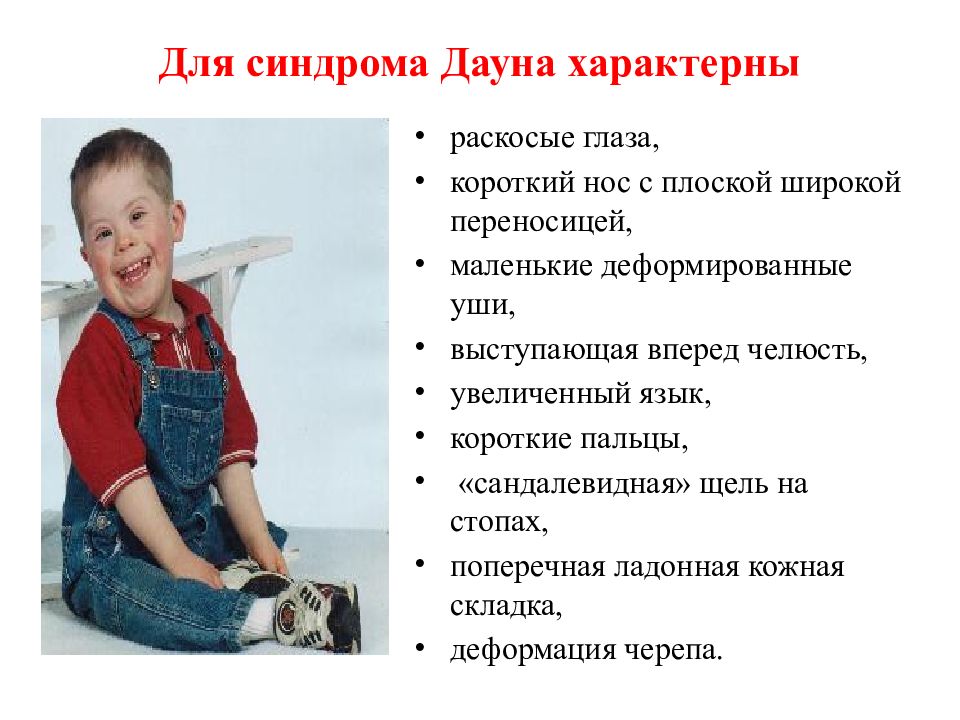 Фенотип ребенка с синдромом дауна. Синдром Дауна. Синдром Дауна характеристика. Синдром Дауна у детей симптомы. Для синдрома Дауна характерны.