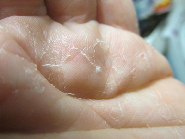 Облазит кожа на пальцах рук: фото, причины, лечение