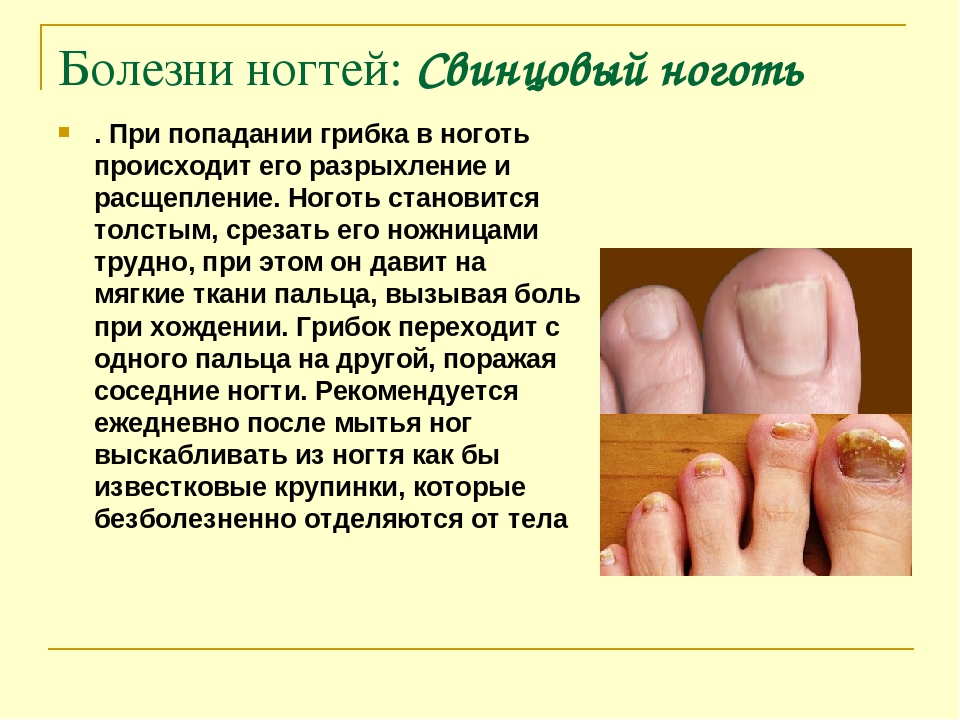 Изменение цвета ногтей: причины, симптом какой болезни | food and health