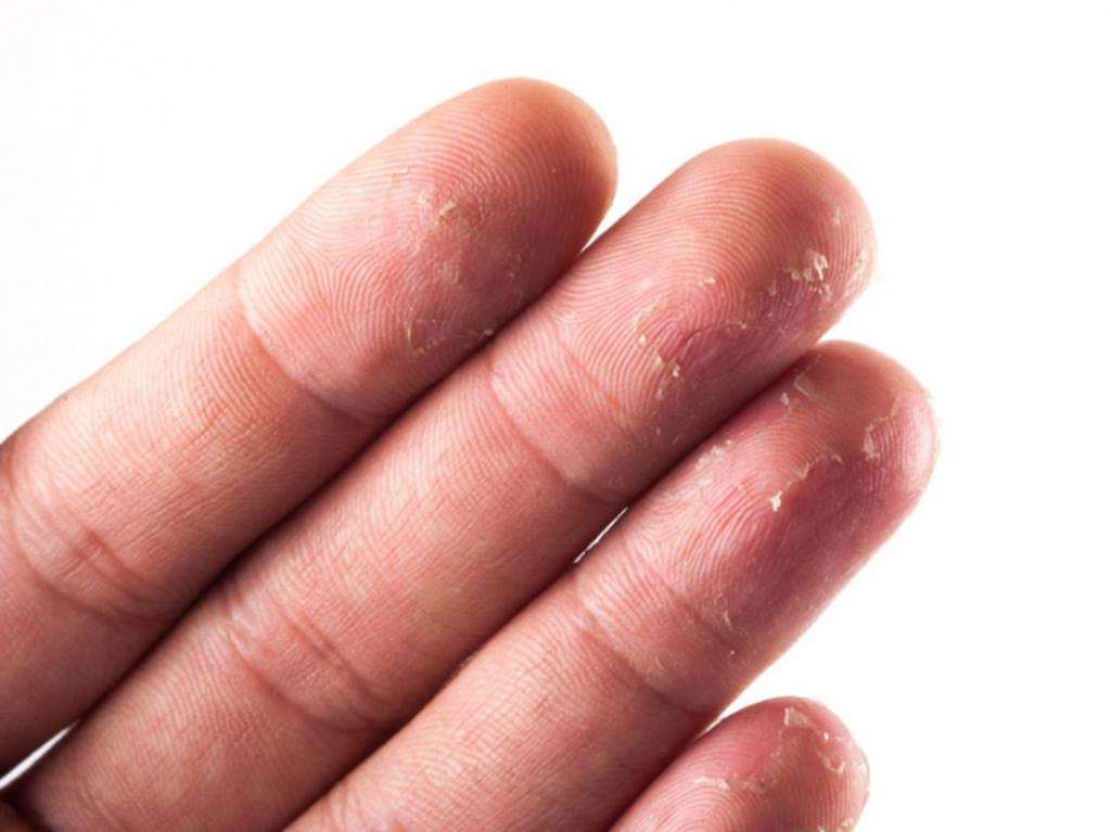 Трескается кожа на пальцах рук около ногтей: причины, симптомы, терапия, профилактика