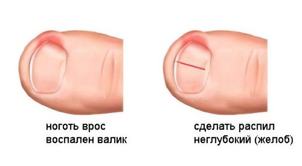 Гнойный артрит - причины, симптомы, лечение