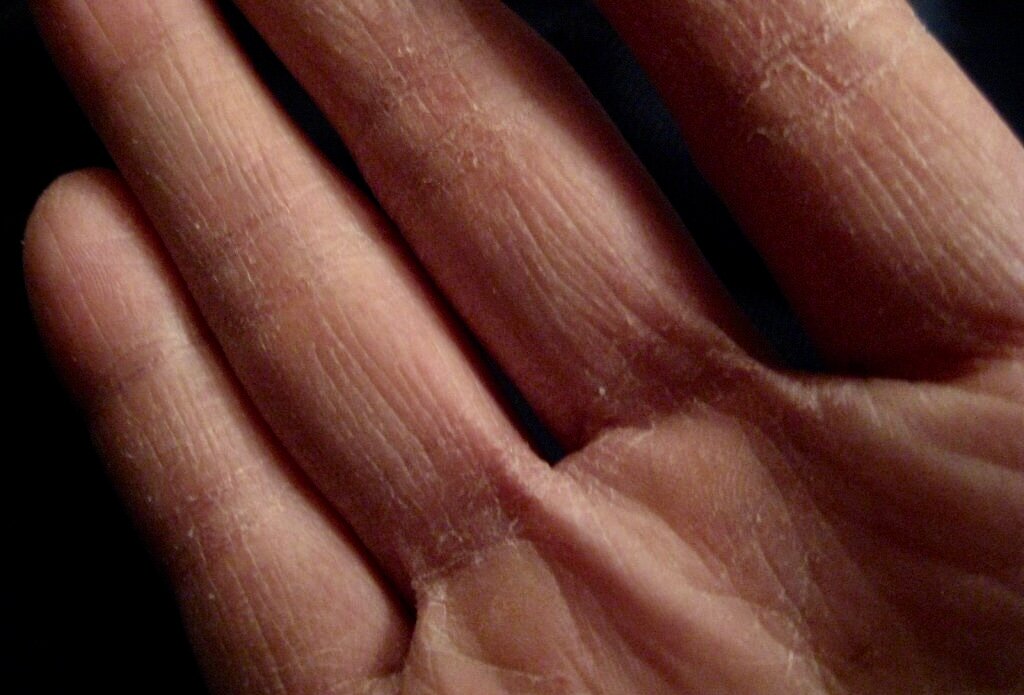 Сухая кожа на пальцах рук: причины сухости на кончиках и подушечках пальцев рук - что делать