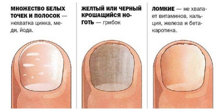 Бороздки на ногтях - 115 фото ребристых ногтей, причины появления ребер и способы лечения