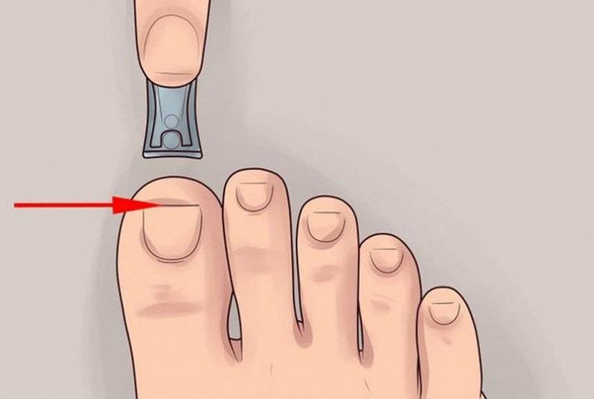 Как правильно подстричь вросший ноготь на большом пальце
