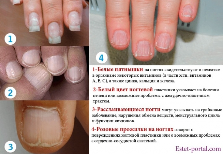 Подногтевая меланома, рак ногтевой пластины: излечение, симптомы, начальная стадия рака ногтя | клиники «евроонко»