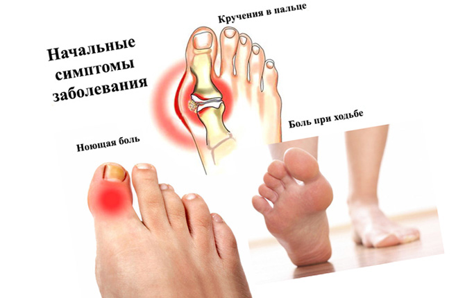 Вальгусная деформация первых пальцев стоп - причины, симптомы, диагностика, лечение и профилактика