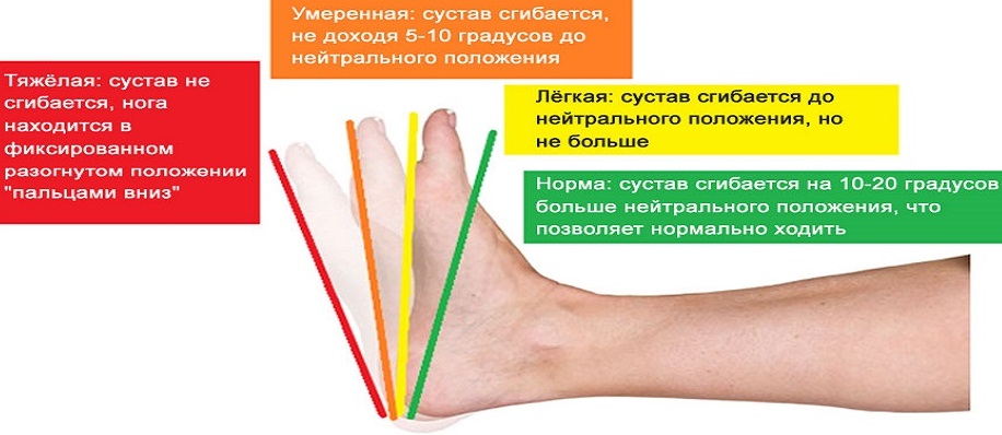 Деформация пятого пальца стопы (деформация тейлора)