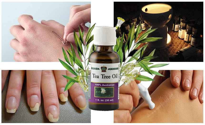 Как использовать масло чайного дерева от грибка ногтей - сайт о ногтях