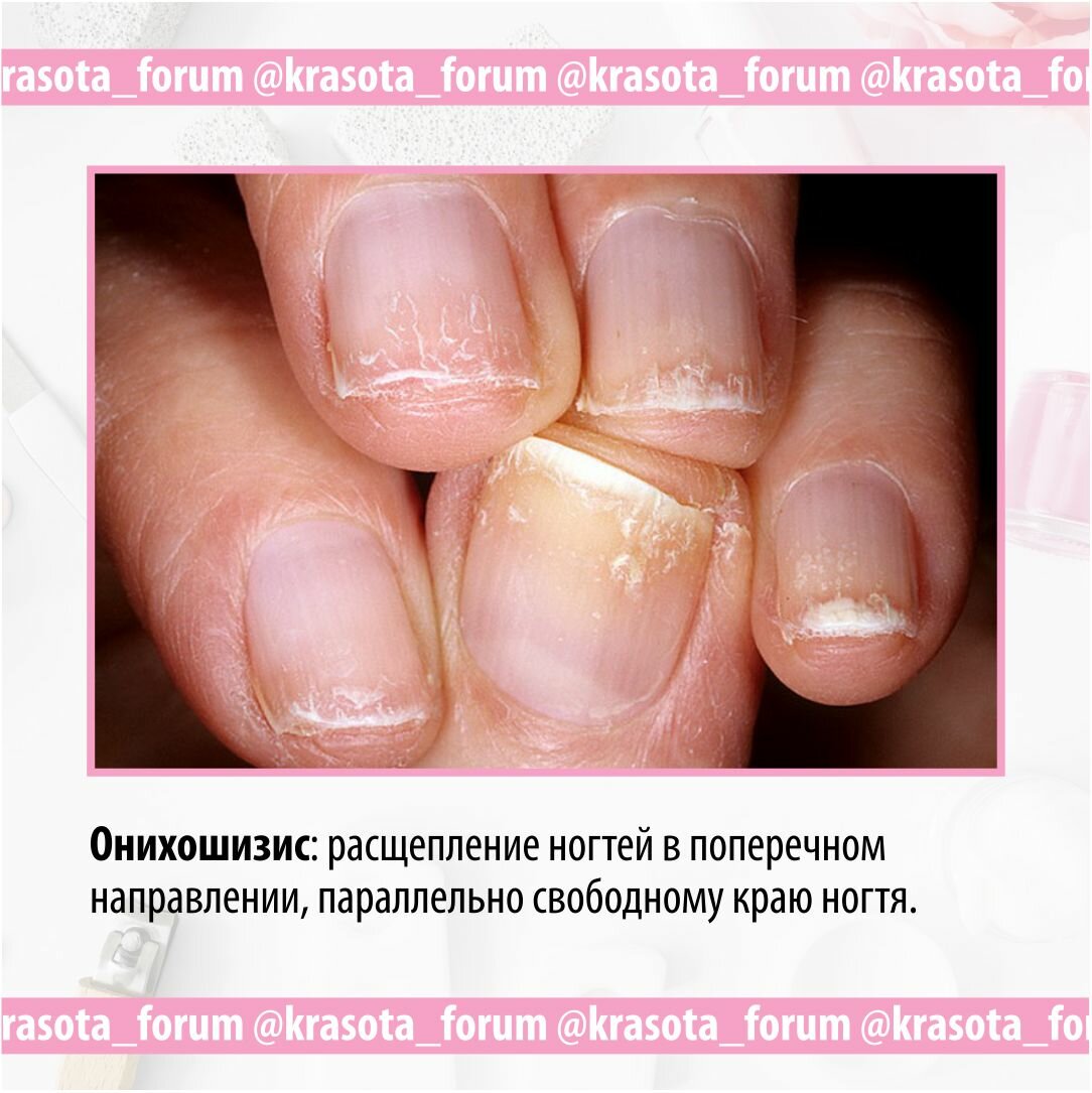 Травма ногтя – необходимые действия