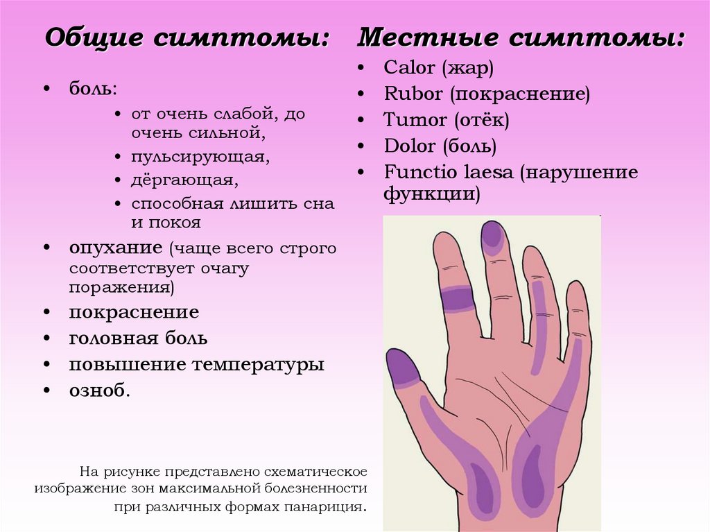 Болят большие пальцы рук лечение. Кожная форма панариция. Панариций Общие симптомы. Общие и местные симптомы.