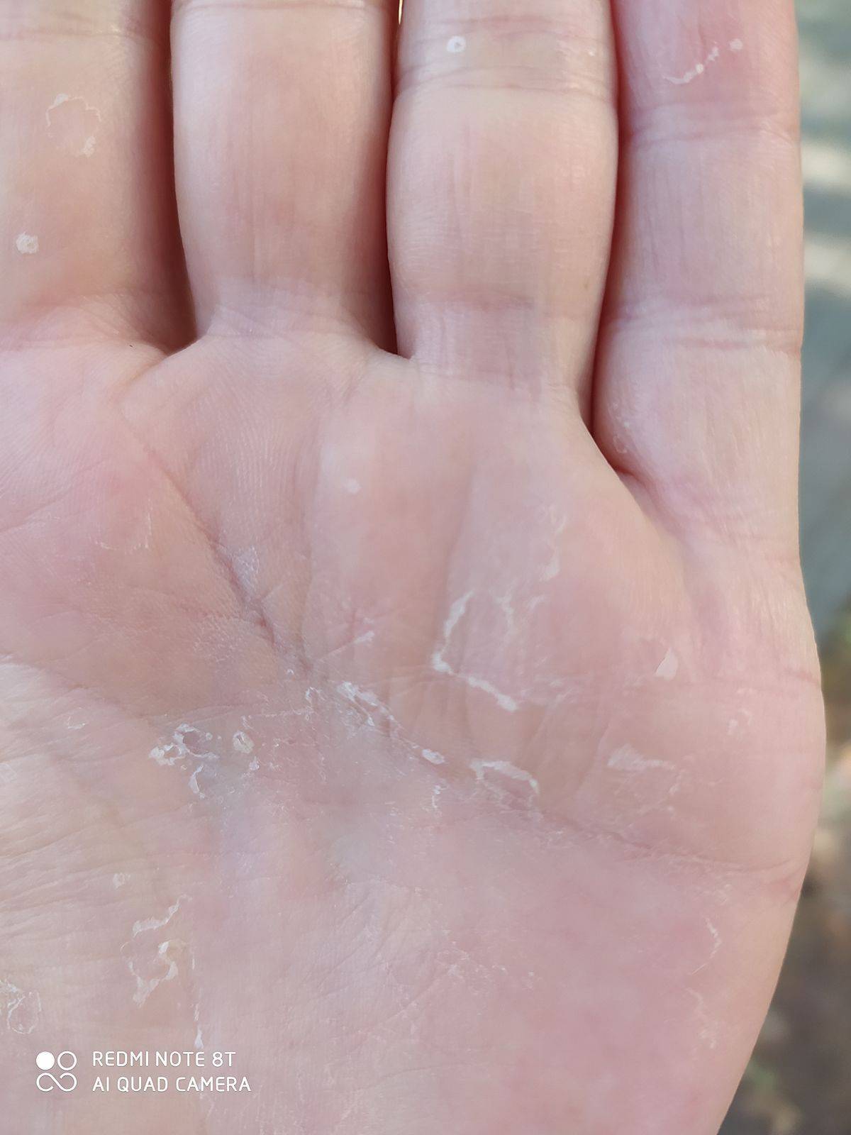 Трещины на пальцах рук. причины и лечение. 4 популярных метода народного врачевания
