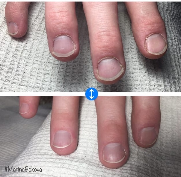 Обкусанные ногти до и после фото у женщин