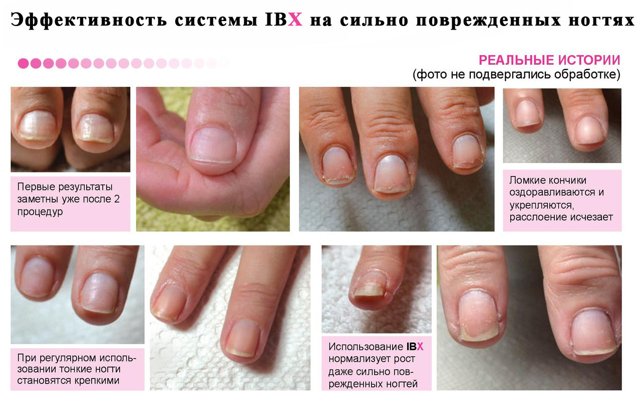 Ногти после процедуры IBX