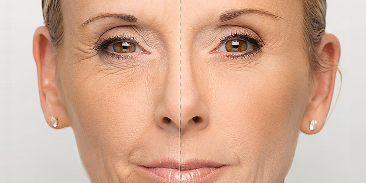 Убрать морщины вокруг глаз косметология фото до и после